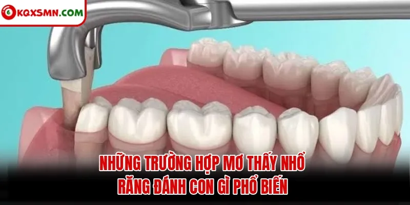 Những trường hợp mơ thấy nhổ răng đánh con gì phổ biến